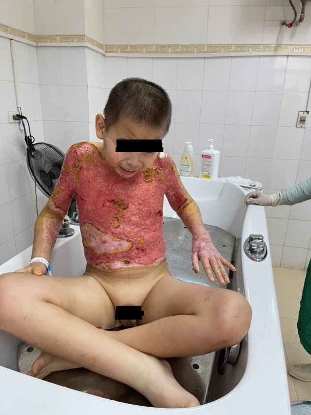 Cảnh báo: Điều trị bỏng nhi tại tuyến cơ sở y tế tư nhân.