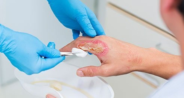 Khám & điều trị Bỏng Người lớn