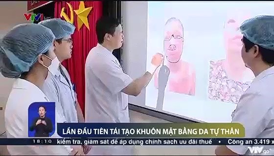 Tái tạo thành công khuôn mặt bằng vạt da tự thân cho bệnh nhân bỏng vùng mặt.