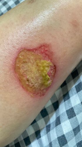 Phòng chống nhiễm trùng ở bệnh nhân bỏng