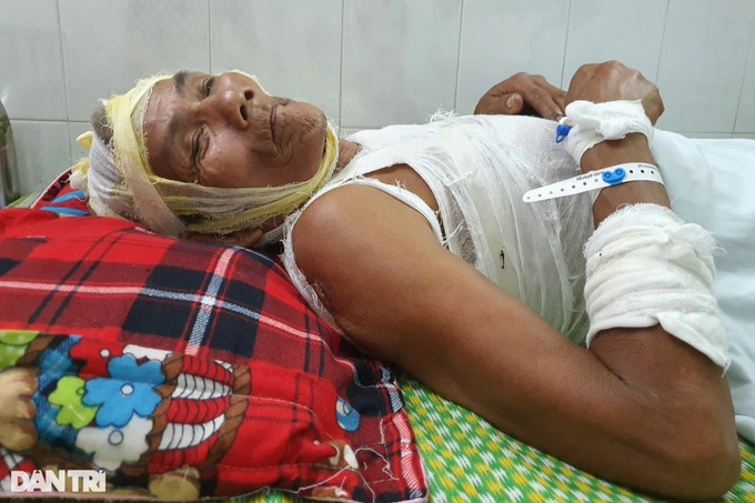 Bác sĩ Bệnh viện Bỏng Quốc gia kêu gọi cứu giúp cụ ông quằn quại trong bếp lửa đỏ