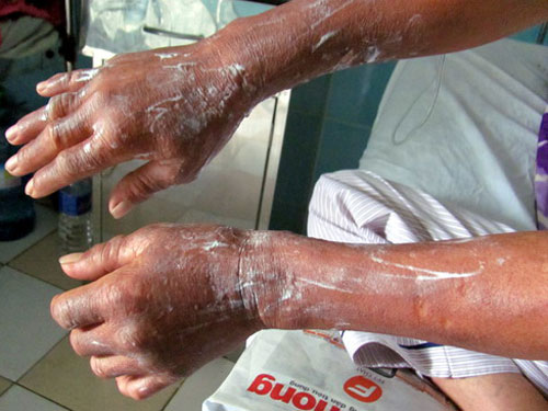 VẾT BỎNG BỊ PHỒNG