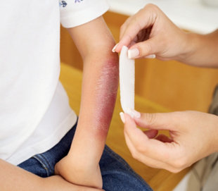 Tôi bị bỏng cồn độ 2