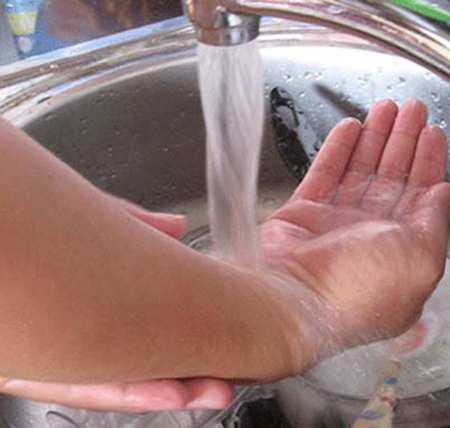 Bỏng vẫn chảy huyết tương nhiều và phù nề