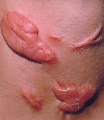 Chữa sẹo lồi