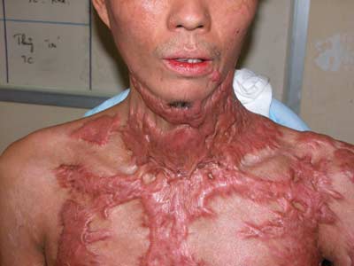 HƯỚNG ĐIỀU TRỊ SẸO LỒI SAU BỎNG CỒN