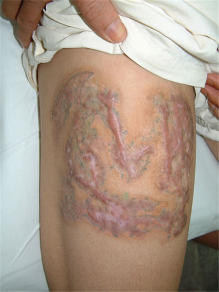 Vá da vùng mắt cá chân