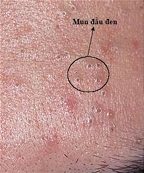 Trị sẹo do mụn trứng cá để lại