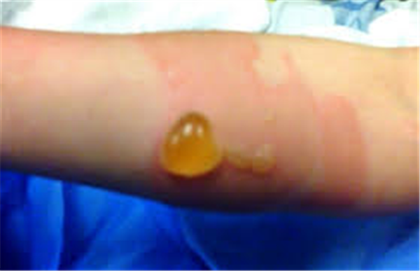 Điều trị sẹo do bổng nước sôi ở đùi