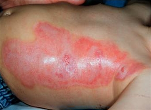 Hỏi về bỏng nước sôi