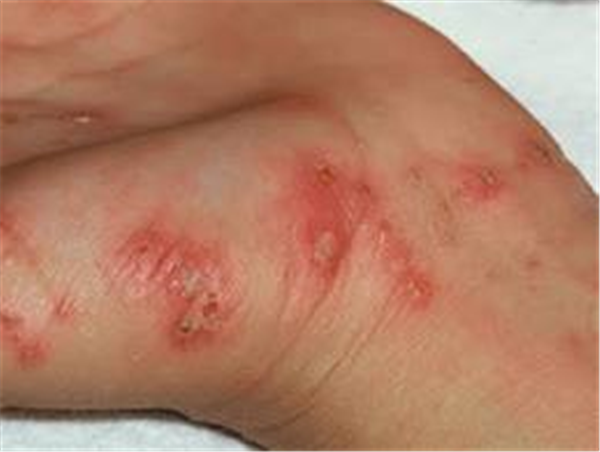 Sẹo bỏng bị sưng và ngứa rát