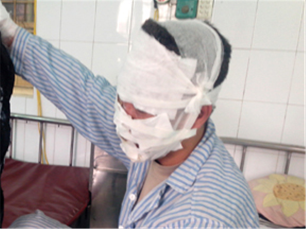 Ghép da mặt do bỏng cồn