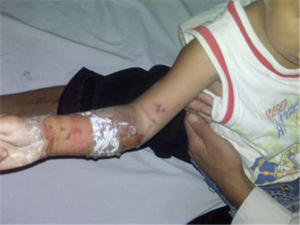 Sẹo bỏng do vôi tôi nóng