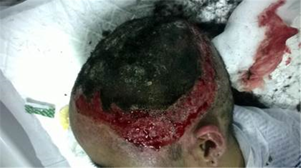 Cảnh báo bỏng sâu vùng đầu do uốn tóc