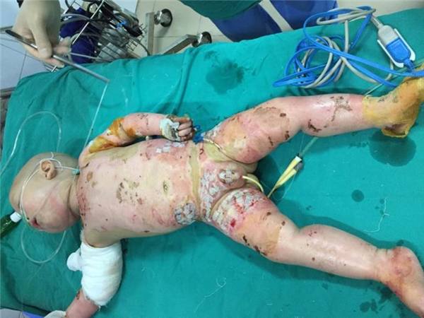 Điều trị thành công bệnh nhân nhi bỏng 64% diện tích cơ thể (4% diện tích bỏng sâu), sốc nhược nặng