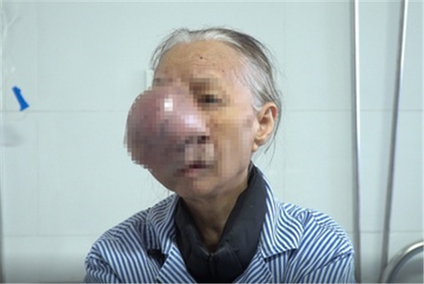 "Hoá giải" thành công khối u "quái" che nửa mặt cụ bà